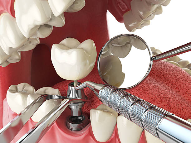 Best Emergency Root Canal Treatment in Clarksburg, MD